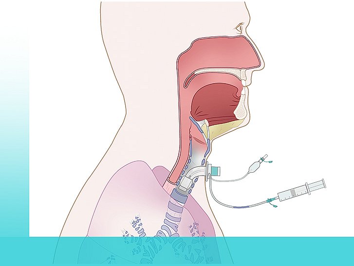 [Translate to Español:] Anatomische Zeichnung Kopf-/Hals Tracheotomierter mit Kanüle und sublgottischer Absaugung